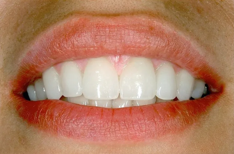 Sorriso dopo il trattamento