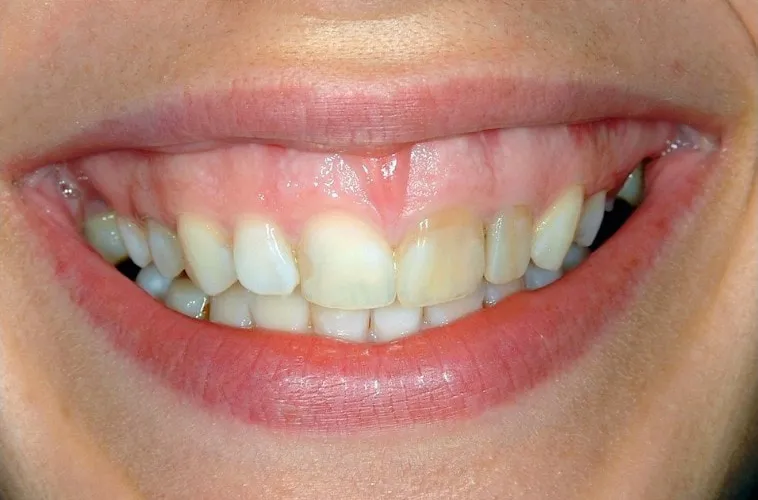 Sorriso prima del trattamento